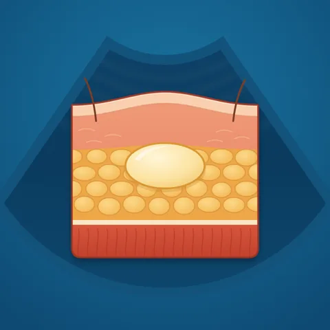 Illustrazione: ecografia di cute e sottocute